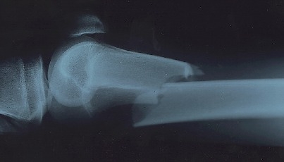 Un uomo ricoverato in ospedale per una patologia renale cade ...